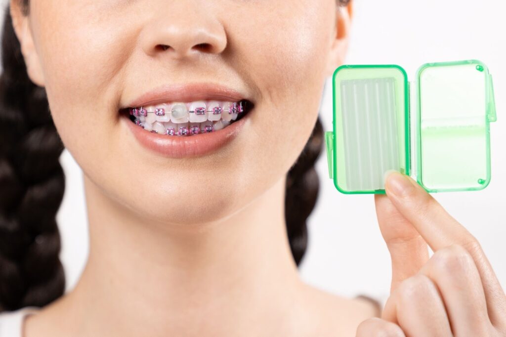 How to Manage Discomfort with Braces