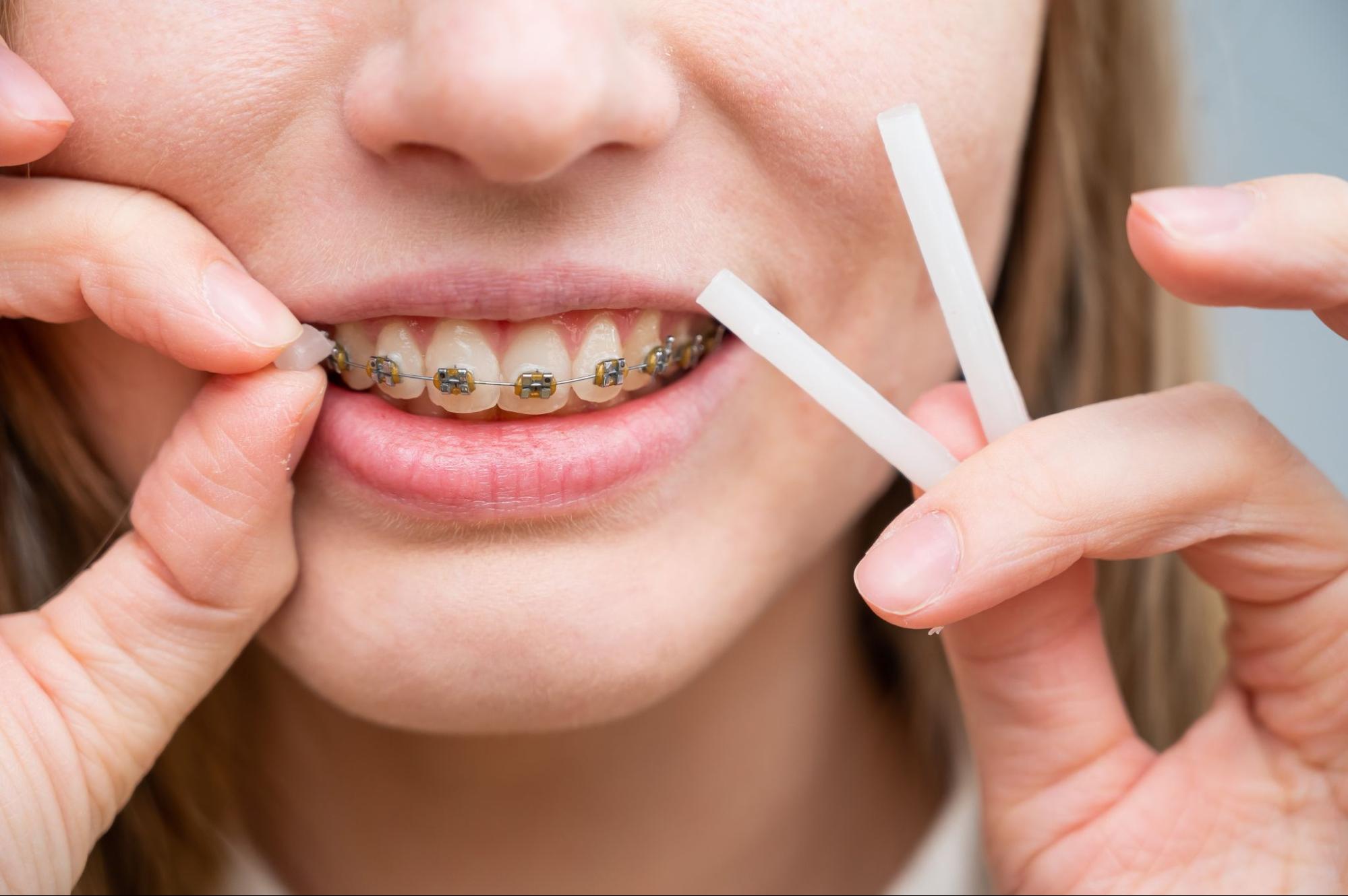 How to Manage Discomfort with Braces